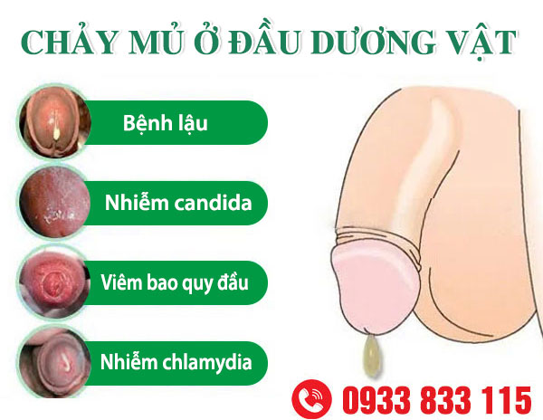 Chảy Mủ Bao Quy Đầu